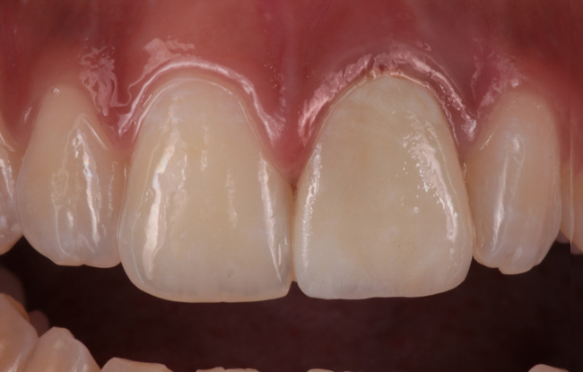 Carillas porcelana y Estética dental